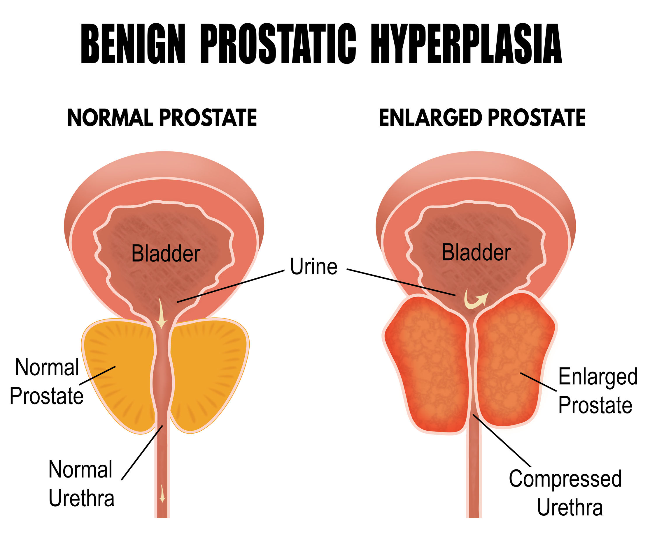 Prostatitis és gyakori vizelés Prosztatagyulladás